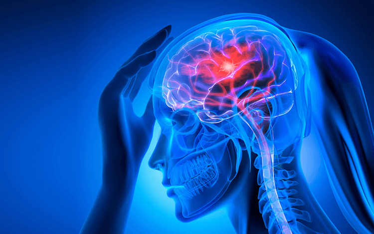 علامات تحذيريّة لا تهملها للسكتة الدماغية.. ستنقذ حياتك!