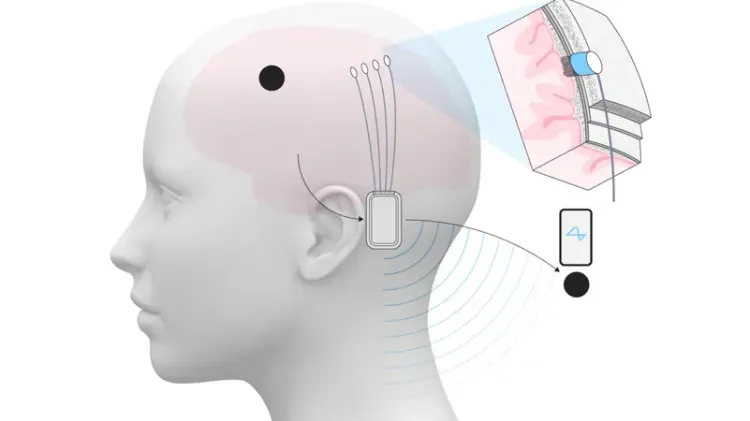 شرائح دماغية مزروعة لدى 12 شخصاً
